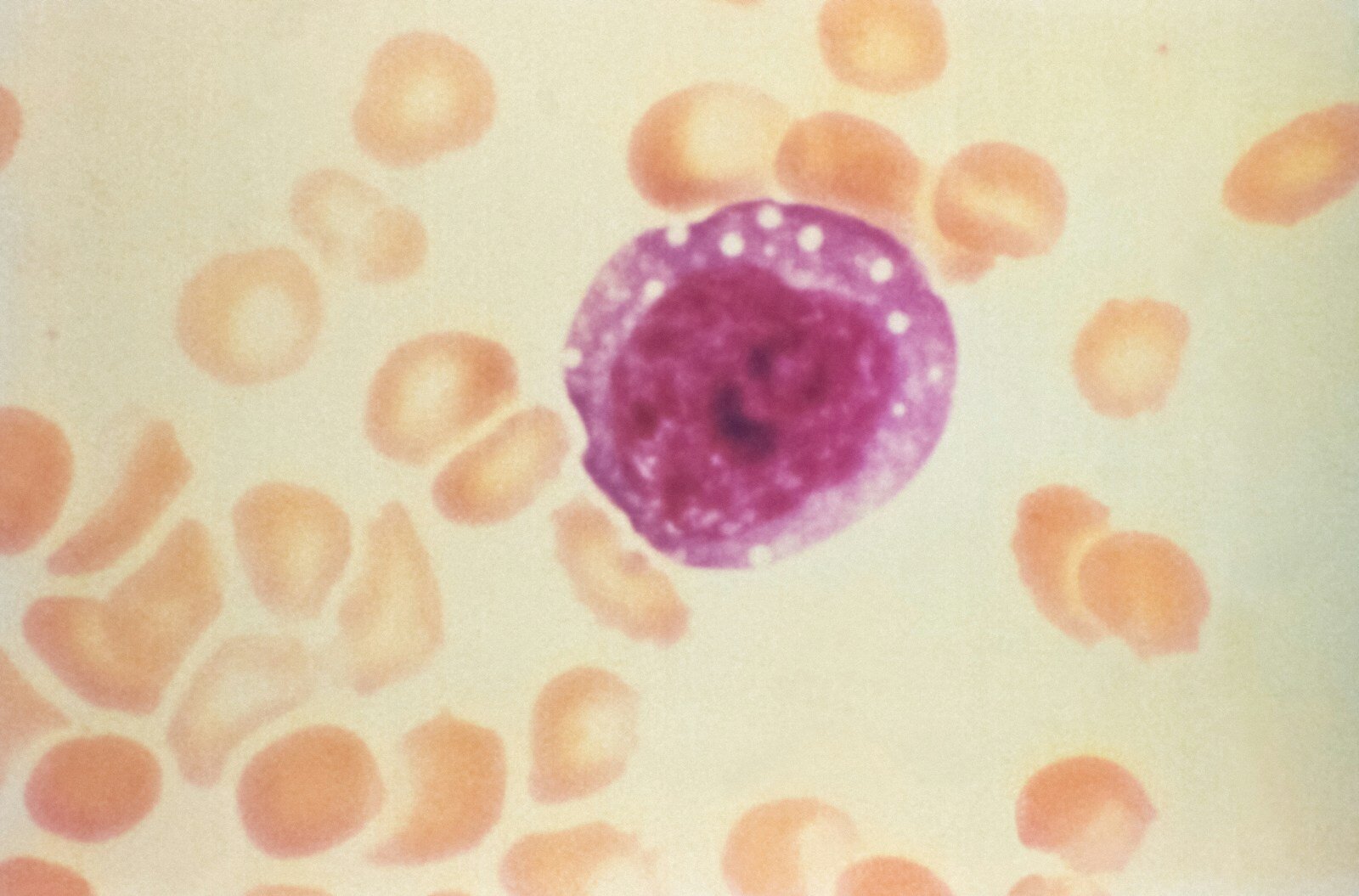 Schule Oberwil-Lieli: Hantavirus 1 A large purple cell surrounded by numerous red blood cells.